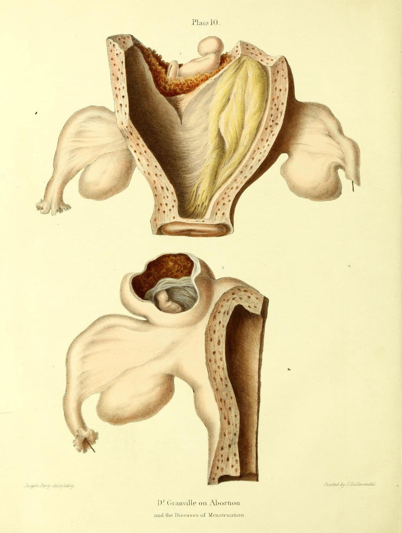Vintage medical illustration of a uterus, labeled 'Plate 10' and 'Dr Granville on Abortion and the Diseases of Menstruation'.